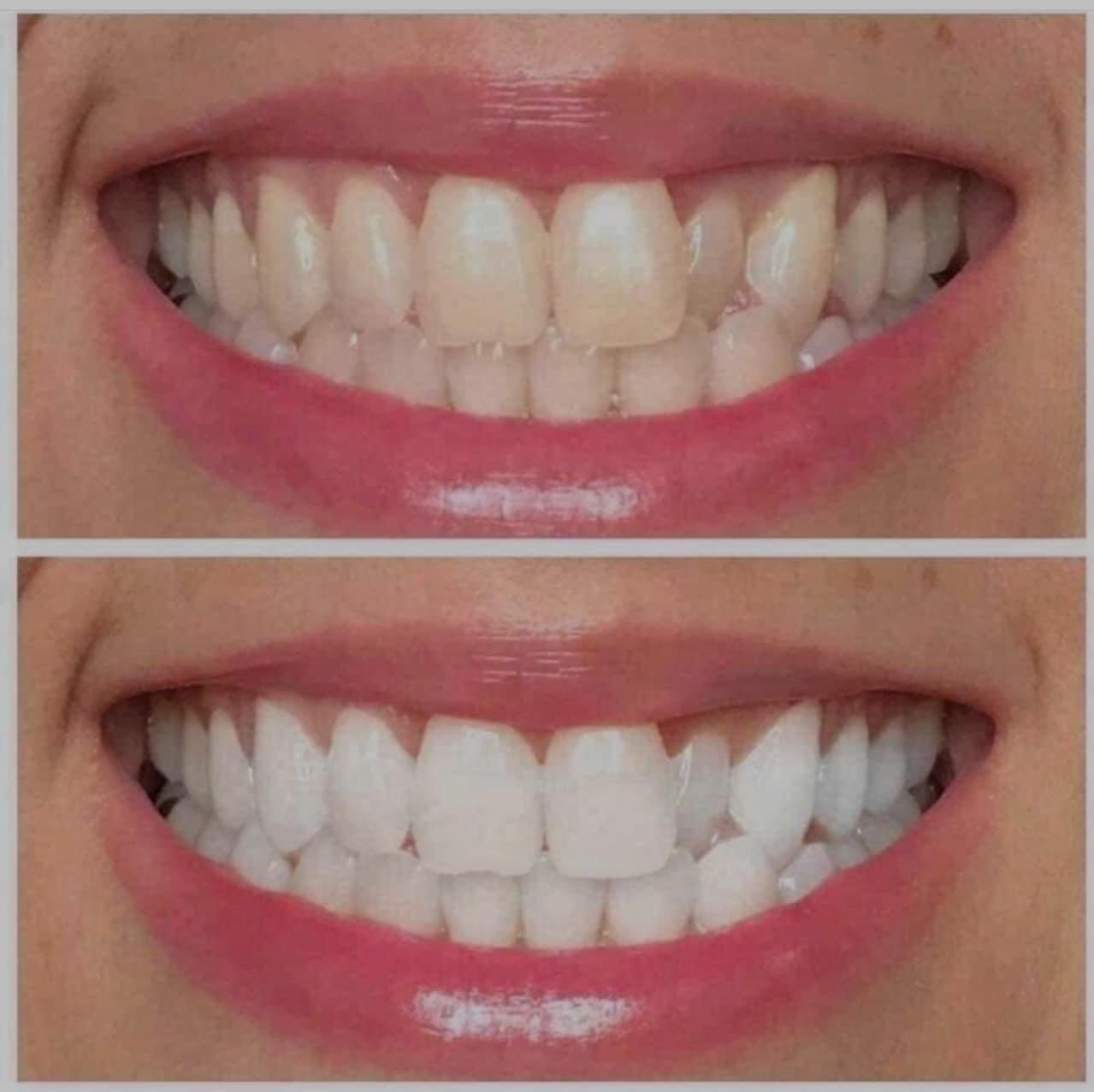 Ultraviolet Pearly White Teeth
Whitening Gel